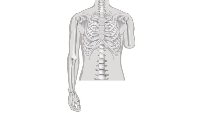 Oberarmamputation
